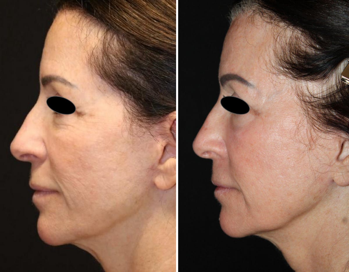CO2 Laser Resurfacing Before & After Gallery - Patient 337273 - Image 1