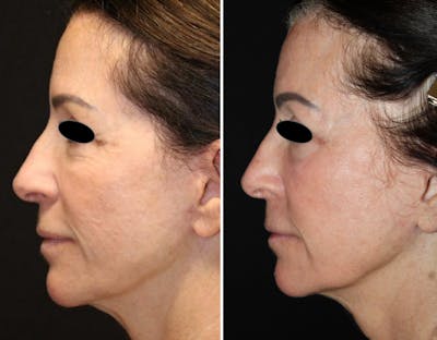 CO2 Laser Resurfacing Before & After Gallery - Patient 337273 - Image 1