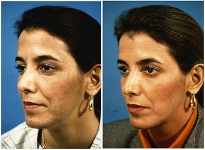Chemical Peel Before & After Gallery - Patient 240715 - Image 1