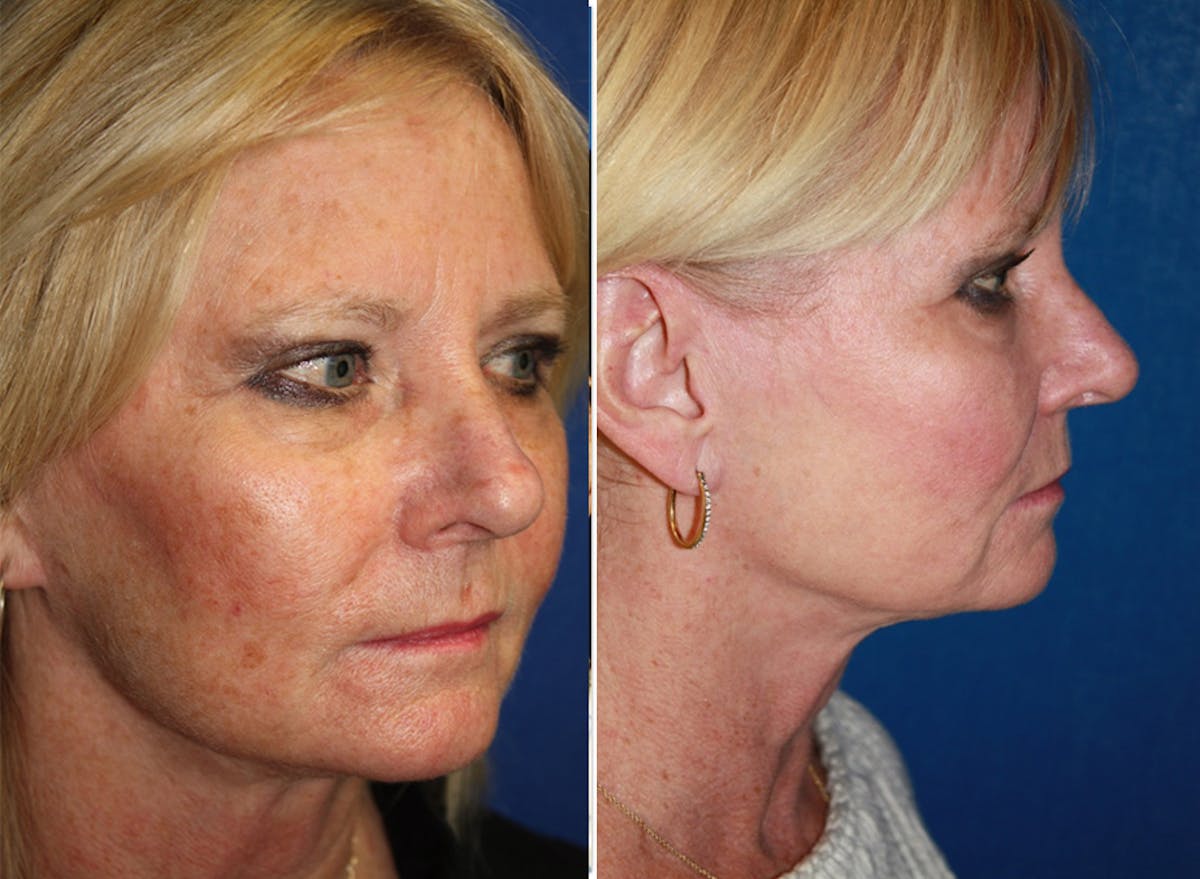 Chemical Peel Before & After Gallery - Patient 255070 - Image 1
