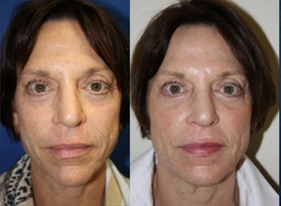 Fat Transfer Before & After Gallery - Patient 540660 - Image 1