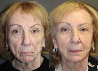 Fat Transfer Before & After Gallery - Patient 221040 - Image 1