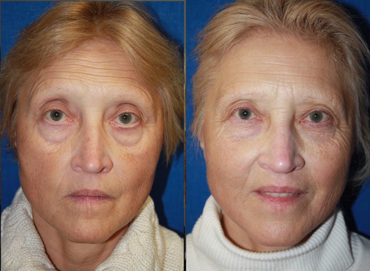 Fat Transfer Before & After Gallery - Patient 213771 - Image 1