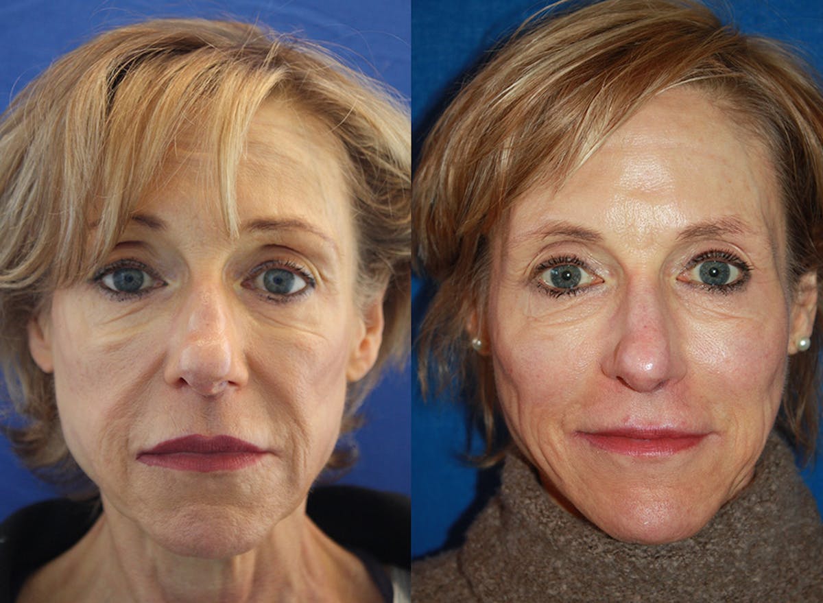 Fat Transfer Before & After Gallery - Patient 212855 - Image 1