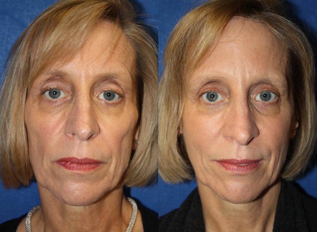 Fat Transfer Before & After Gallery - Patient 351337 - Image 1