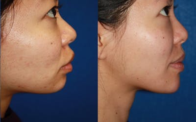 Fat Transfer Before & After Gallery - Patient 353617 - Image 1