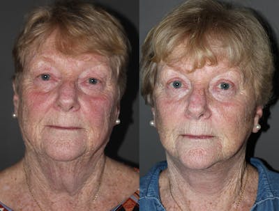 Facelift Before & After Gallery - Patient 694024 - Image 1