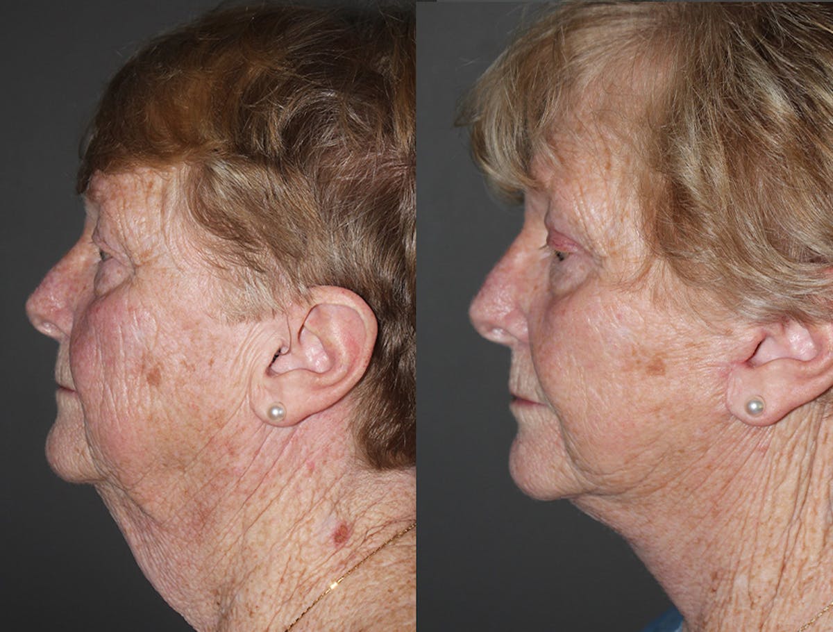 Facelift Before & After Gallery - Patient 694024 - Image 2