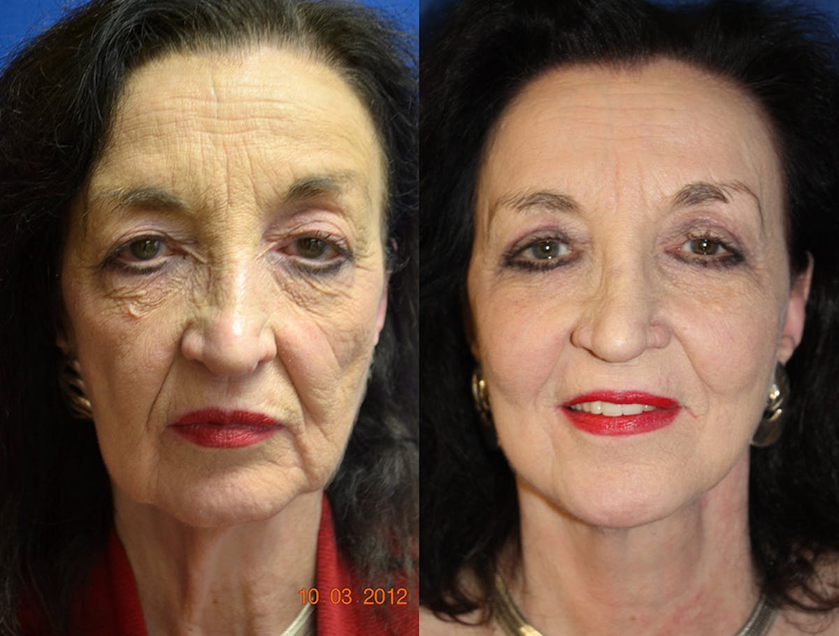 Facelift Before & After Gallery - Patient 290971 - Image 1