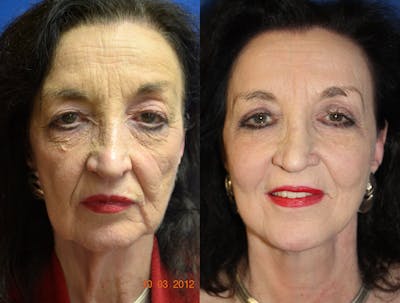 Facelift Before & After Gallery - Patient 290971 - Image 1
