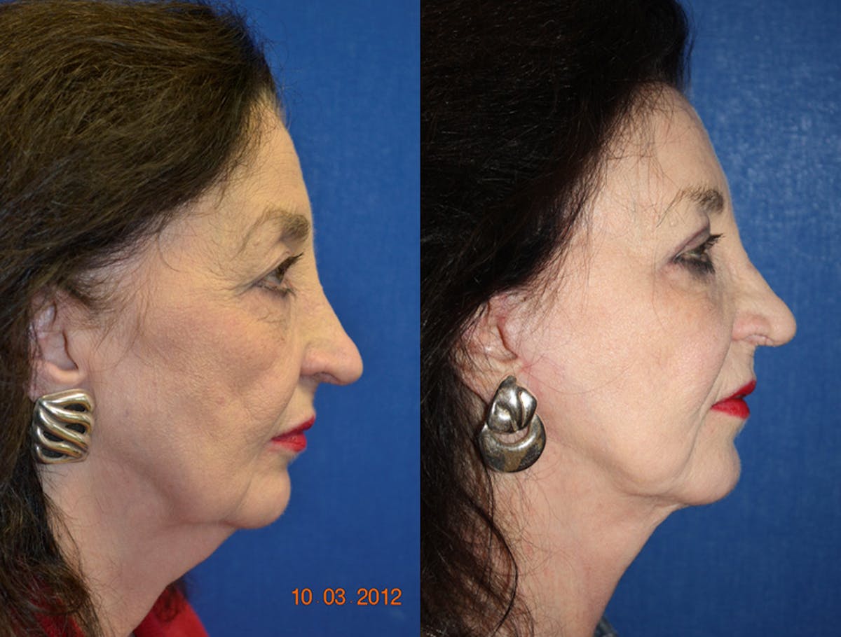 Facelift Before & After Gallery - Patient 290971 - Image 2