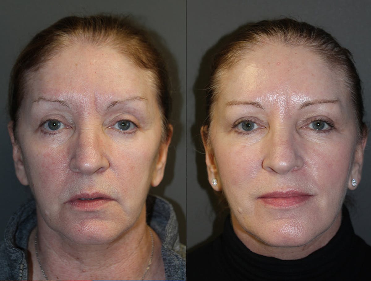 Facelift Before & After Gallery - Patient 300397 - Image 1