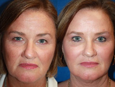 Facelift Before & After Gallery - Patient 170399 - Image 1