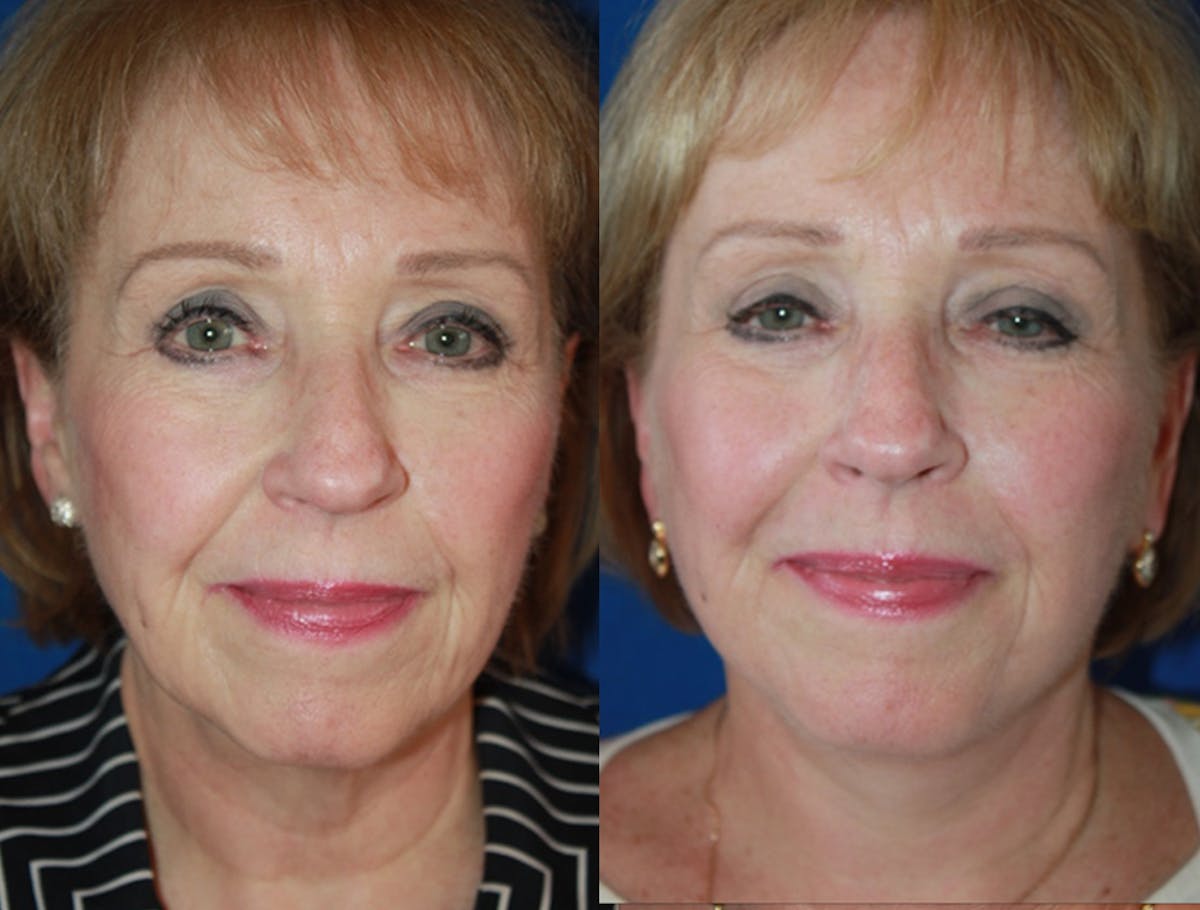 Facelift Before & After Gallery - Patient 952370 - Image 1