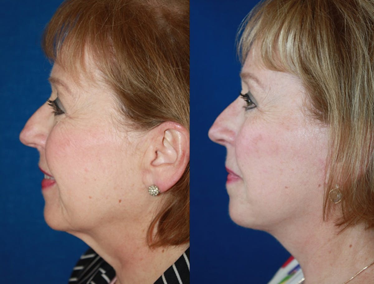 Facelift Before & After Gallery - Patient 952370 - Image 2