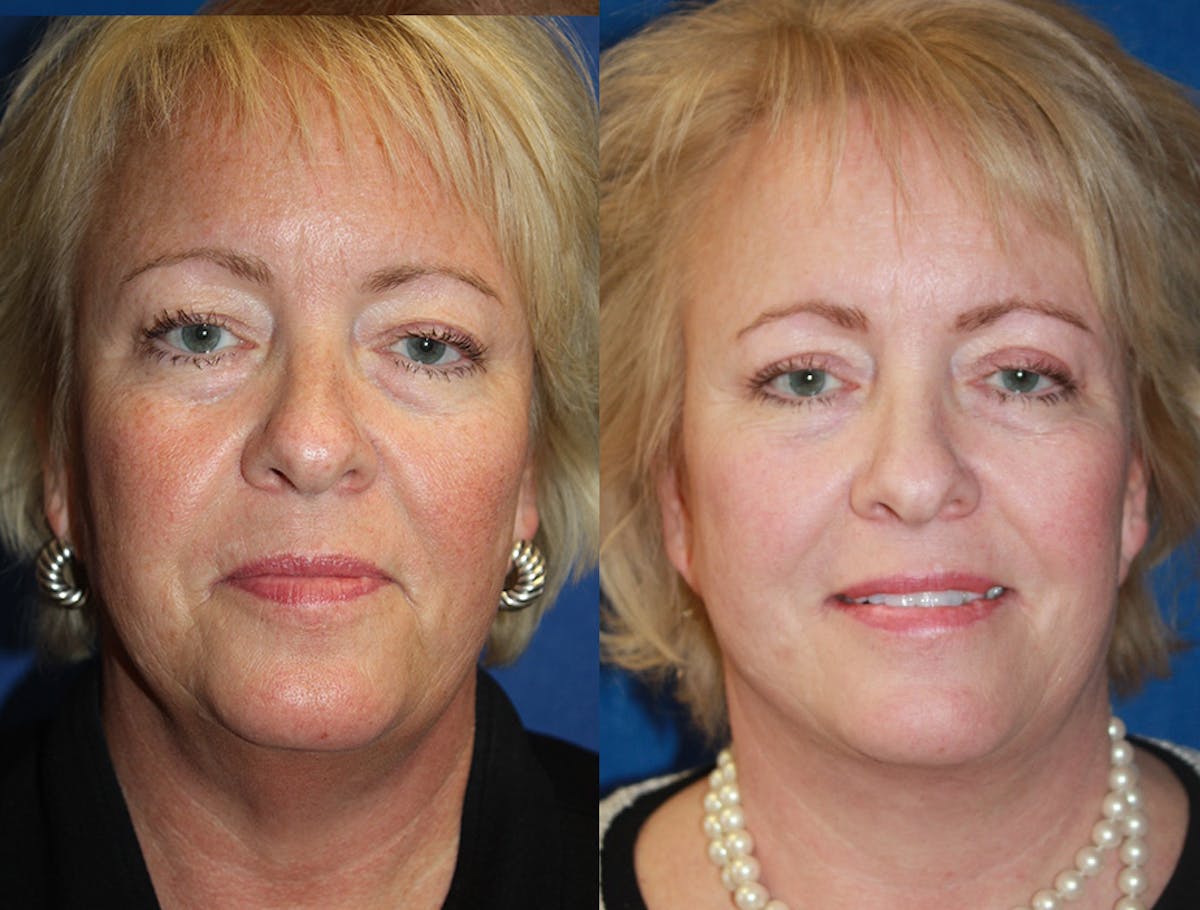 Facelift Before & After Gallery - Patient 264163 - Image 1
