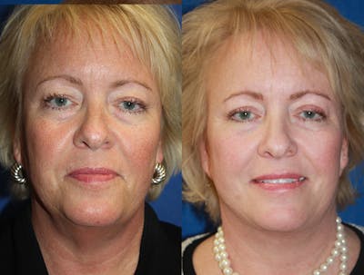 Facelift Before & After Gallery - Patient 264163 - Image 1