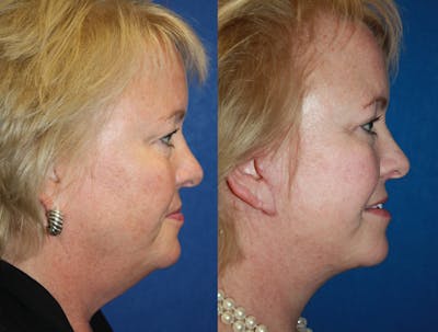 Facelift Before & After Gallery - Patient 264163 - Image 1