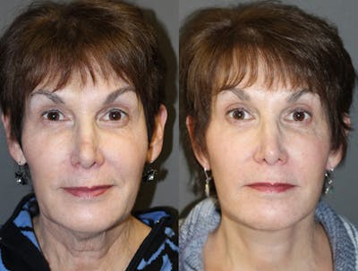 Facelift Before & After Gallery - Patient 317530 - Image 1