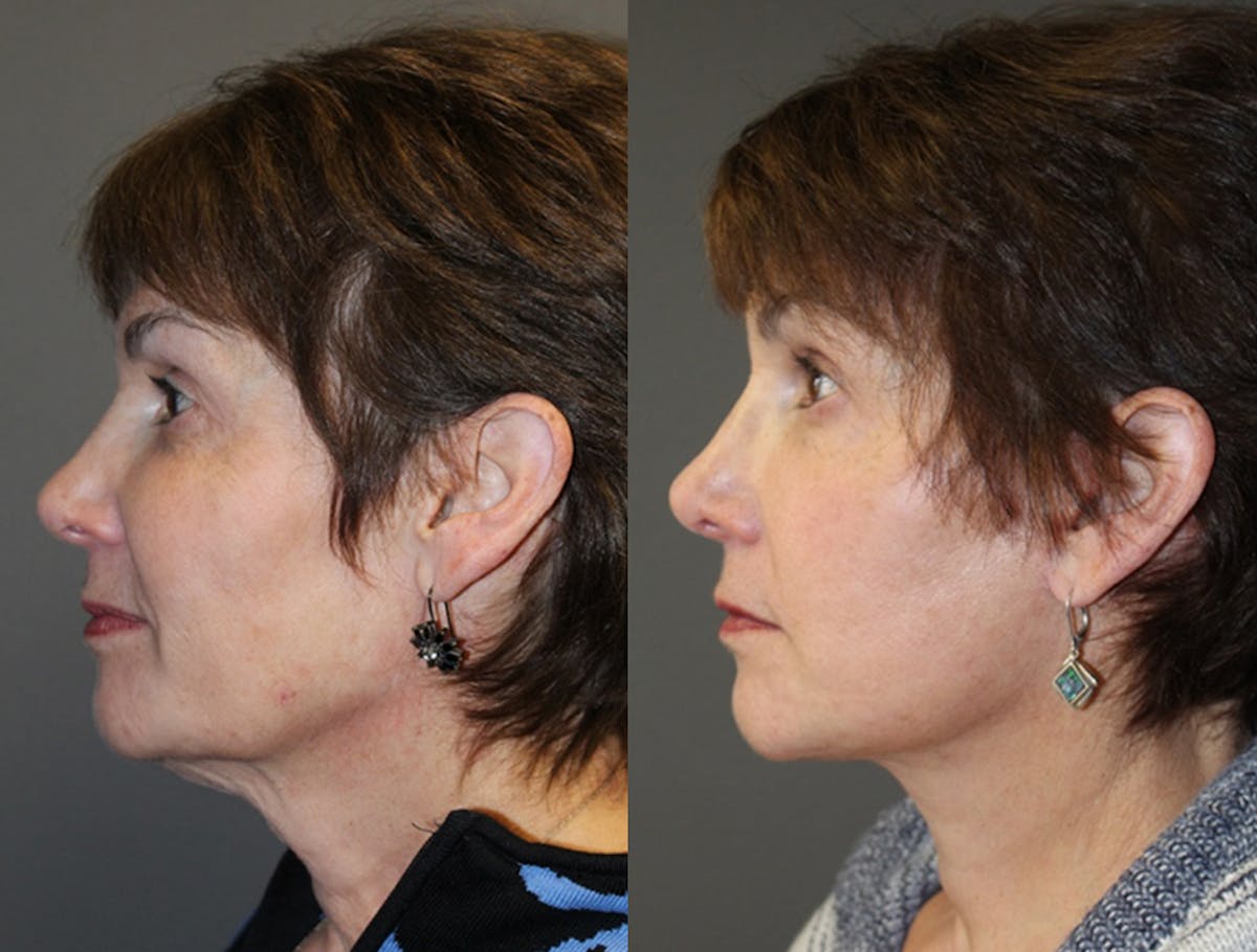 Facelift Before & After Gallery - Patient 317530 - Image 2