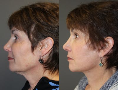 Facelift Before & After Gallery - Patient 317530 - Image 1