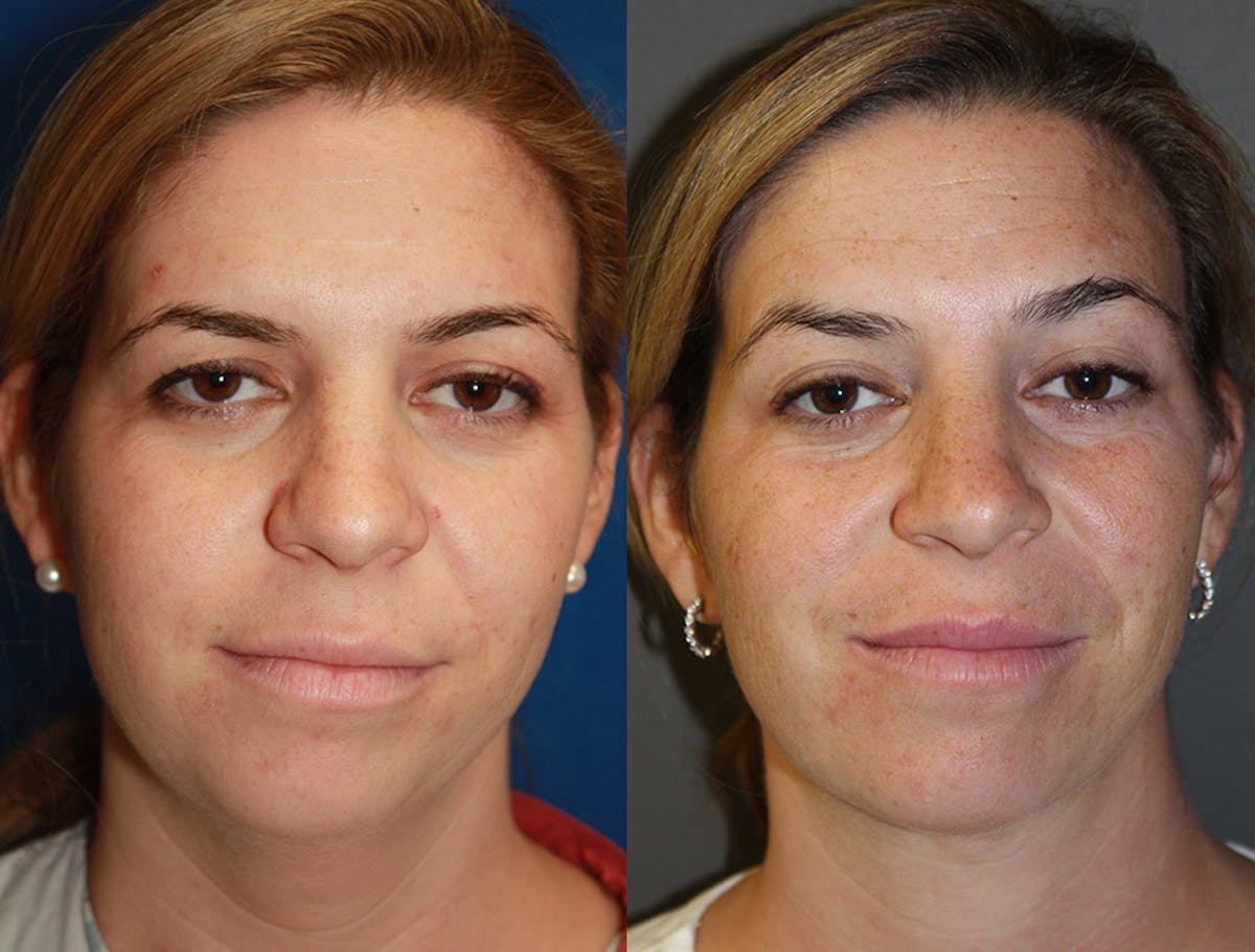 Neck Liposuction Before & After Gallery - Patient 289316 - Image 2