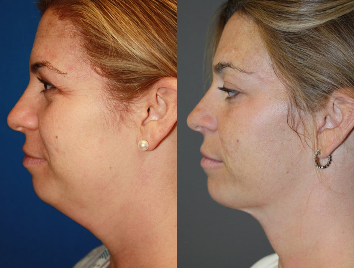 Neck Liposuction Before & After Gallery - Patient 289316 - Image 1