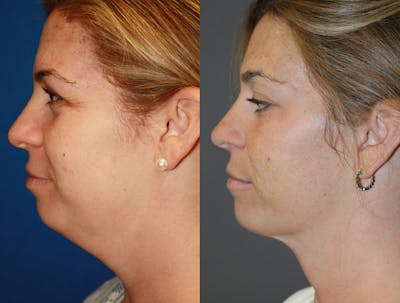 Neck Liposuction Before & After Gallery - Patient 289316 - Image 1