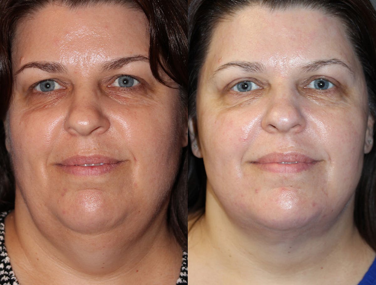 Neck Liposuction Before & After Gallery - Patient 708606 - Image 2