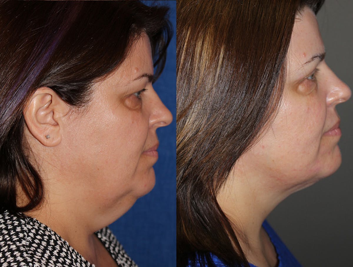 Neck Liposuction Before & After Gallery - Patient 708606 - Image 1