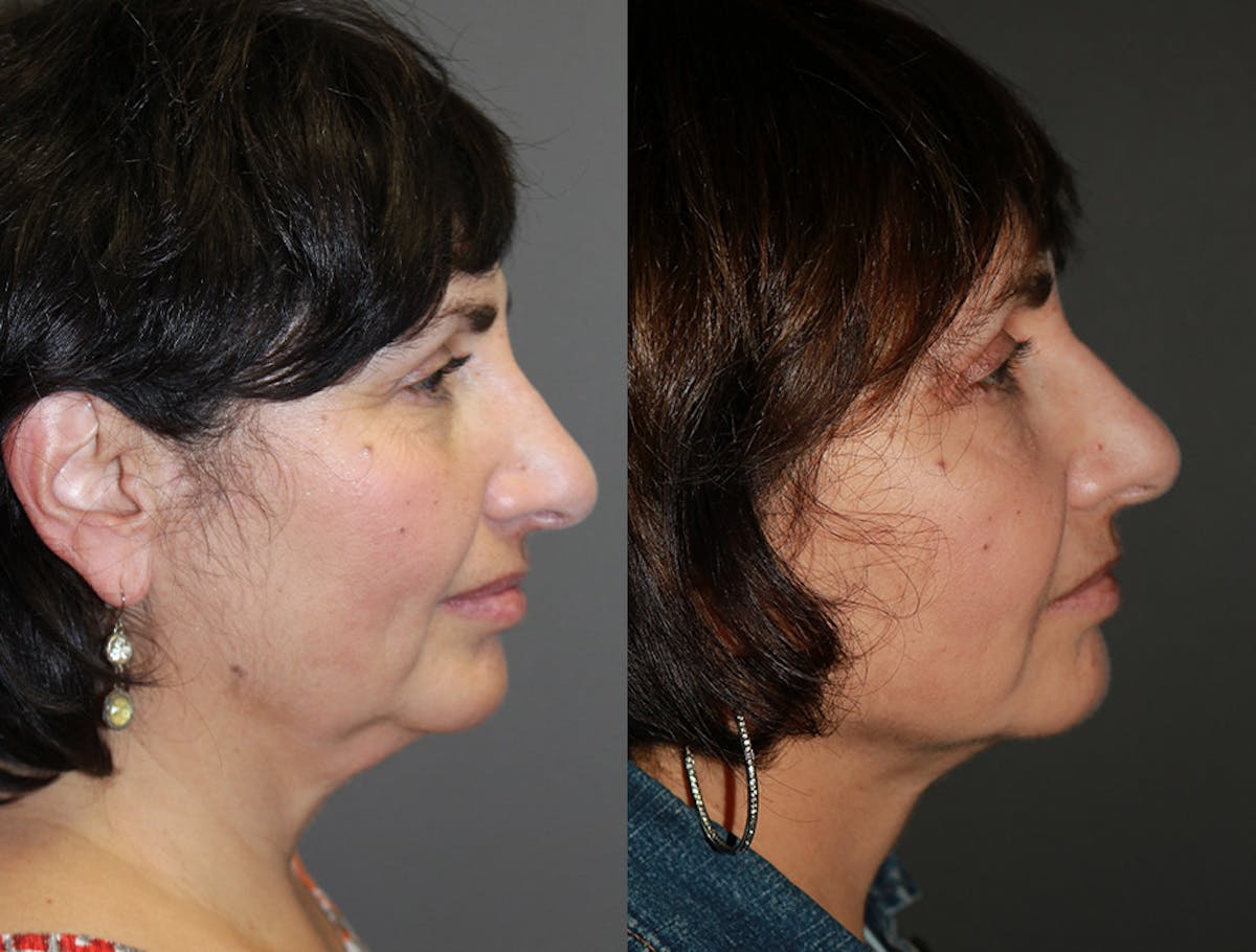 Neck Liposuction Before & After Gallery - Patient 149868 - Image 1