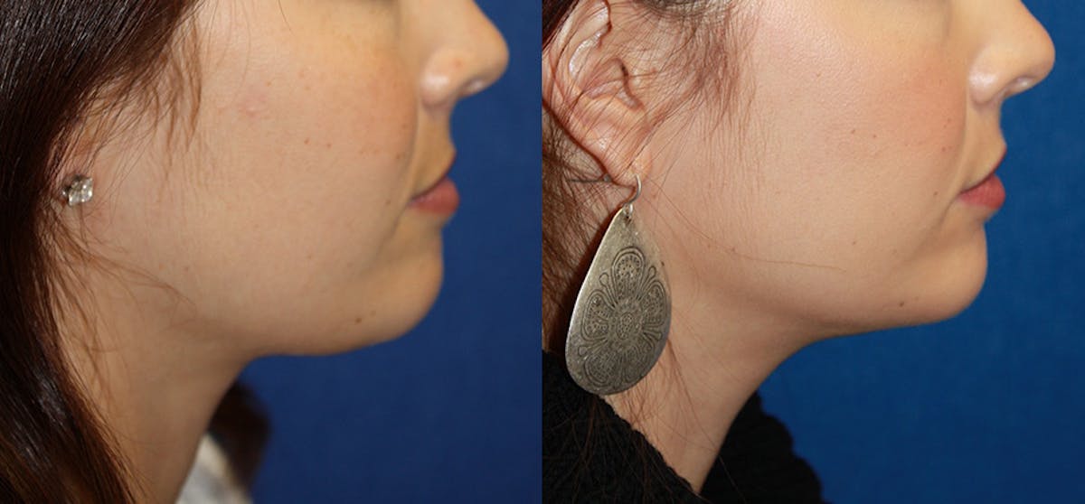 Neck Liposuction Before & After Gallery - Patient 381345 - Image 1