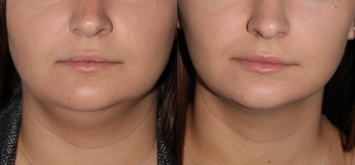 Kybella Before & After Gallery - Patient 571117 - Image 2