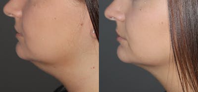Kybella Before & After Gallery - Patient 571117 - Image 1