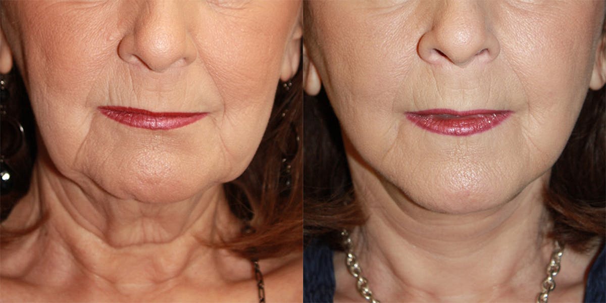 Neck Rejuvenation Before & After Gallery - Patient 758936 - Image 2