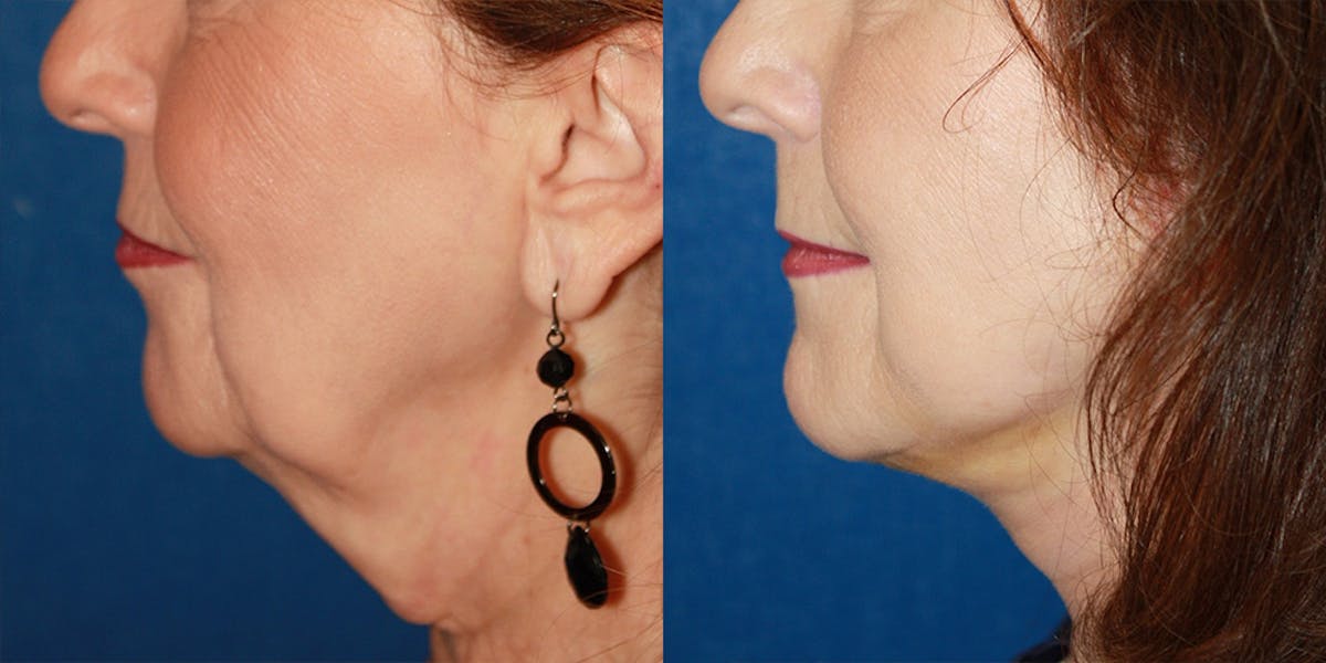 Neck Rejuvenation Before & After Gallery - Patient 758936 - Image 1