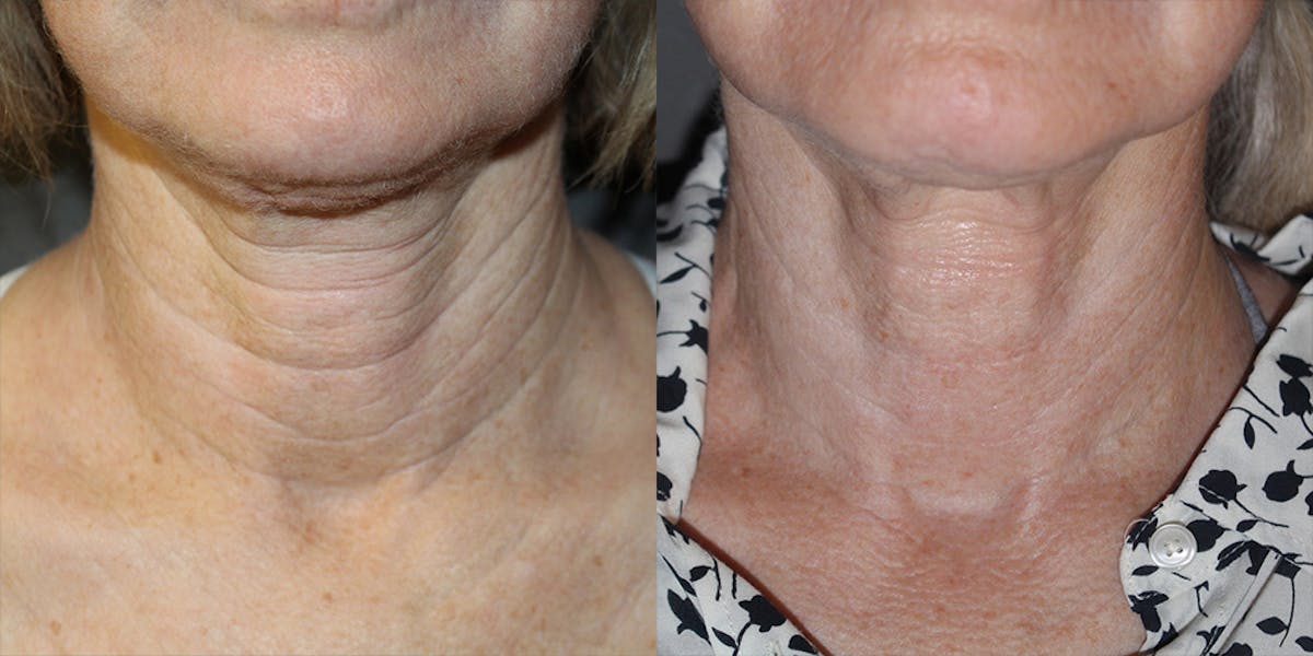 Neck Rejuvenation Before & After Gallery - Patient 304044 - Image 1