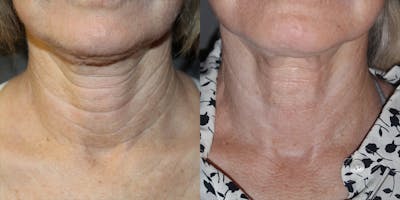 Neck Rejuvenation Before & After Gallery - Patient 304044 - Image 1
