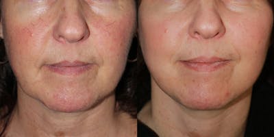Vein Treatment Before & After Gallery - Patient 721891 - Image 1