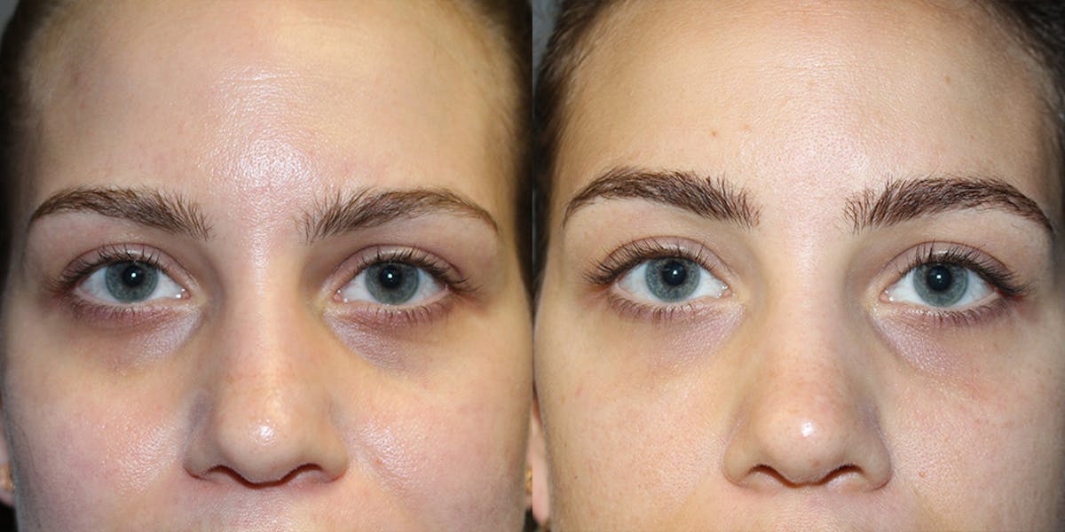 Dermal Fillers Before & After Gallery - Patient 319263 - Image 1