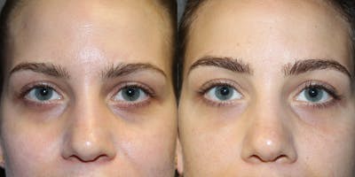 Dermal Fillers Before & After Gallery - Patient 319263 - Image 1