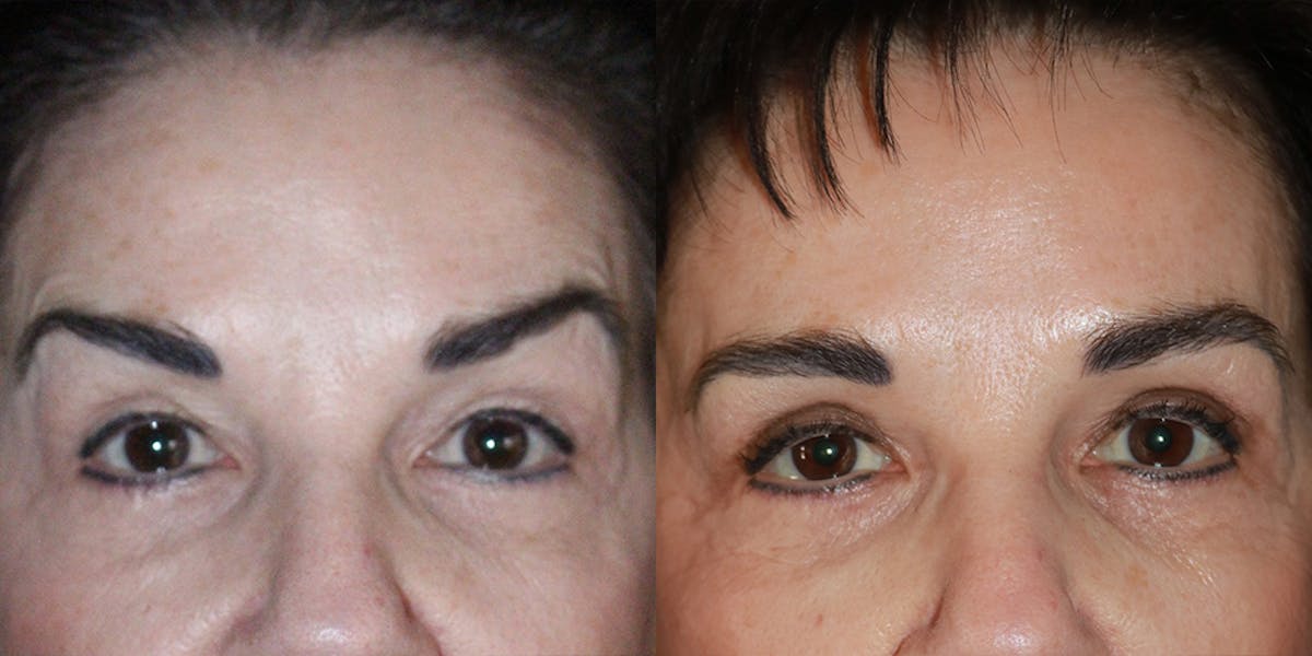 Botox Before & After Gallery - Patient 627665 - Image 1