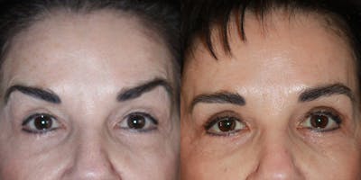 Botox Before & After Gallery - Patient 627665 - Image 1