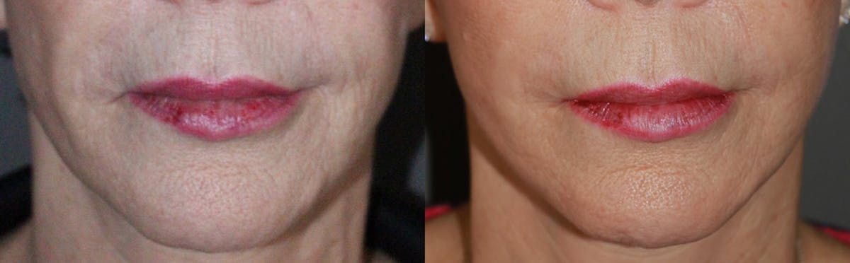 Lip Augmentation Before & After Gallery - Patient 215962 - Image 1