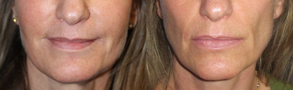 Lip Augmentation Before & After Gallery - Patient 164022 - Image 1
