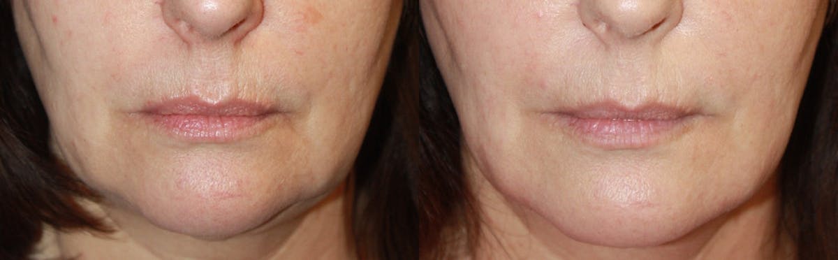Lip Augmentation Before & After Gallery - Patient 309913 - Image 1