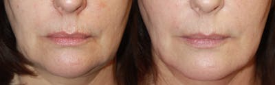 Lip Augmentation Before & After Gallery - Patient 309913 - Image 1
