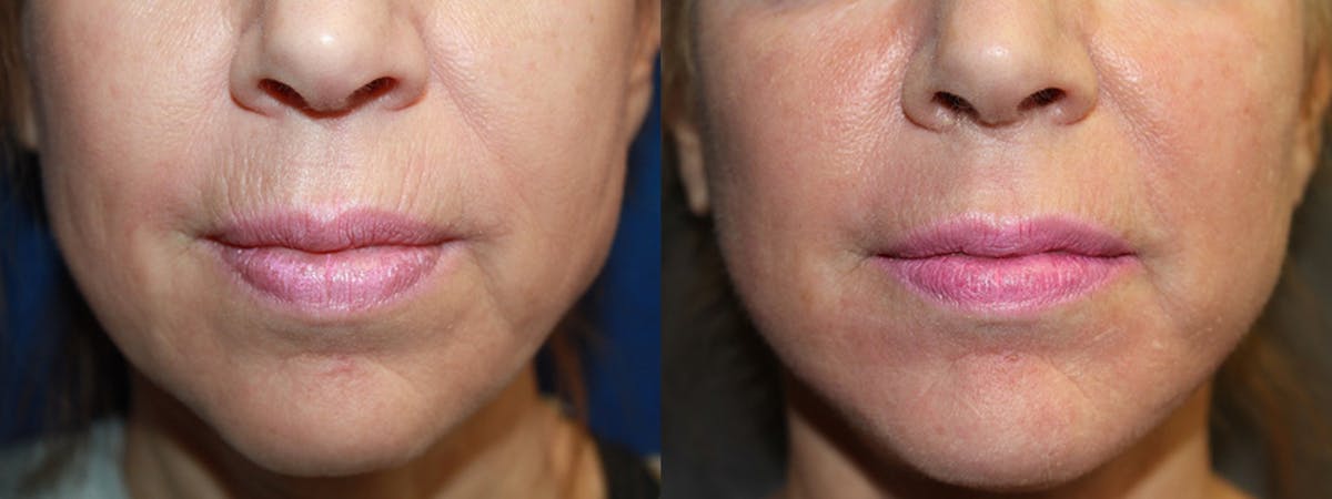 Microneedling Before & After Gallery - Patient 131537 - Image 1
