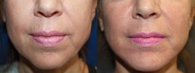 Microneedling Before & After Gallery - Patient 131537 - Image 1