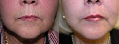 Microneedling Before & After Gallery - Patient 134883 - Image 1